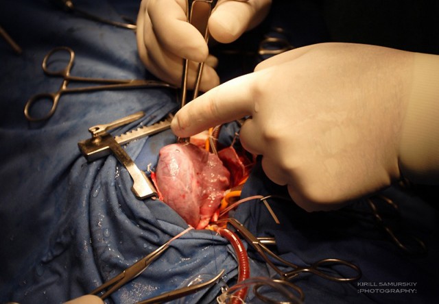 В Симферополе прошла уникальная операция на открытом сердце