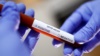 Пробирка с кровью человека, зараженного коронавирусом 2019-nCoV. Лаборатория в США